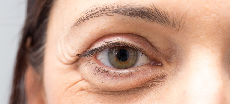 Bags Under Eyes: Symptoms and How to get rid of eyebags