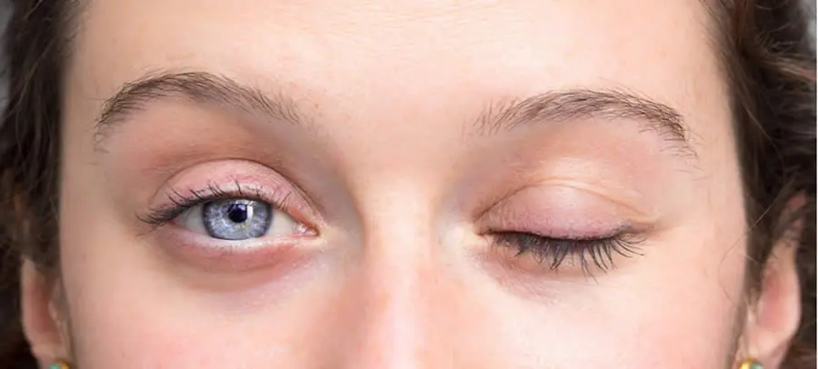 Bell’s palsy: How it affects the eye