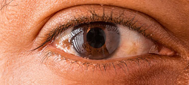 Eye melanoma