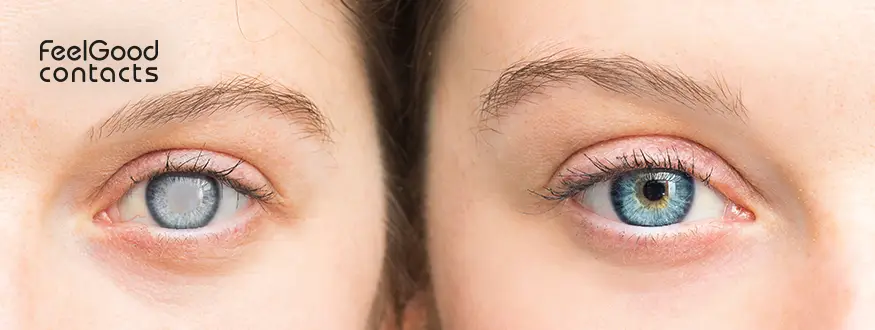 Cataracts eye vs normal eye