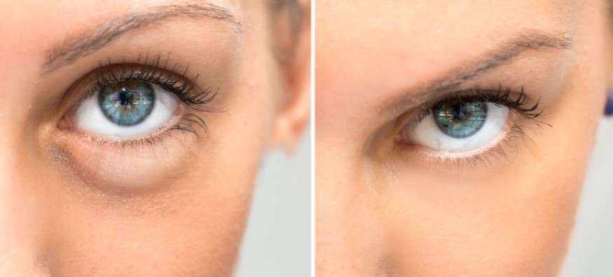 Bags Under Eyes: How To Get Rid of Eye Bags