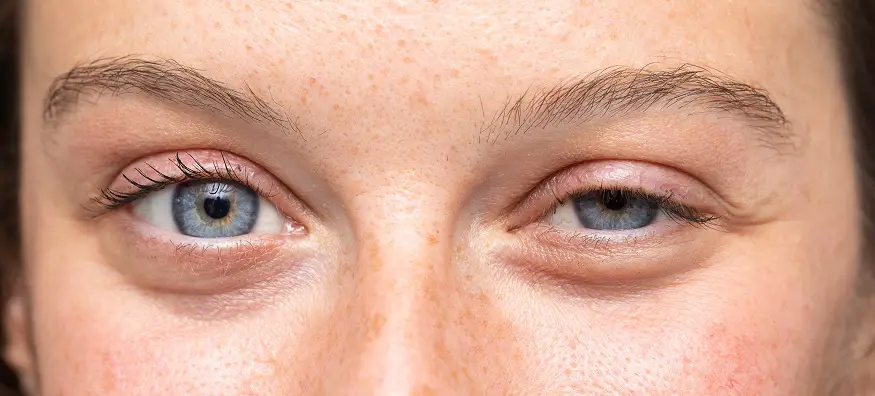 Person staring with one droopy eyelid