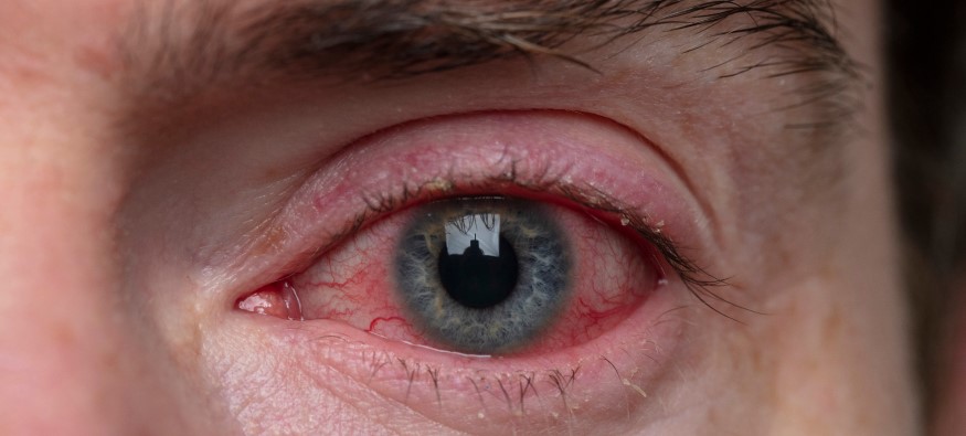 Red Eye Causes Symptoms 