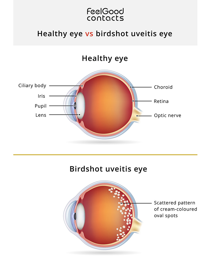 Healthy eye vs Birdshot eye