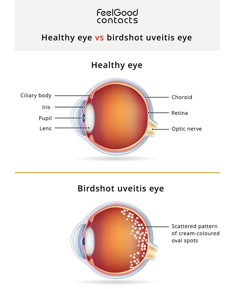 Birdshot Chorioretinopathy