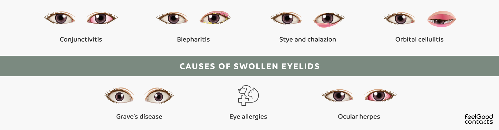 Causes of Swollen Eyelids