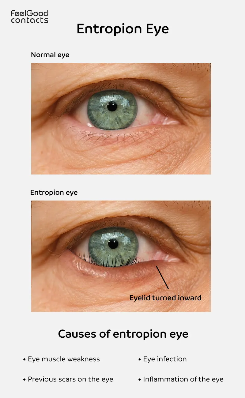 Normal eye vs entropion eye, causes of entropion eye