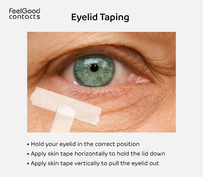 Eyelid taping technique for entropion eye