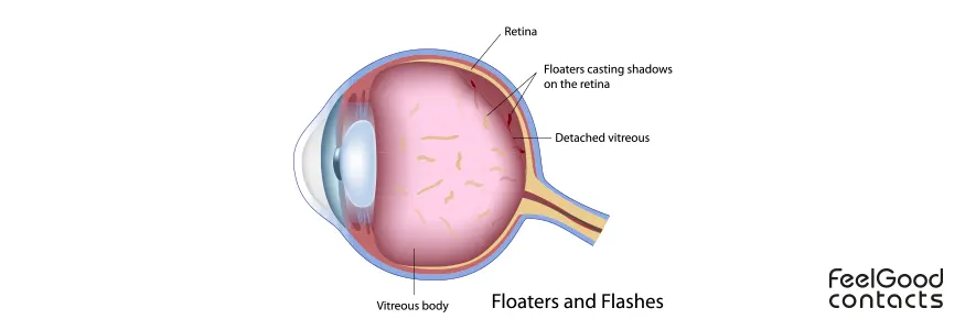 Graphical representation of floaters