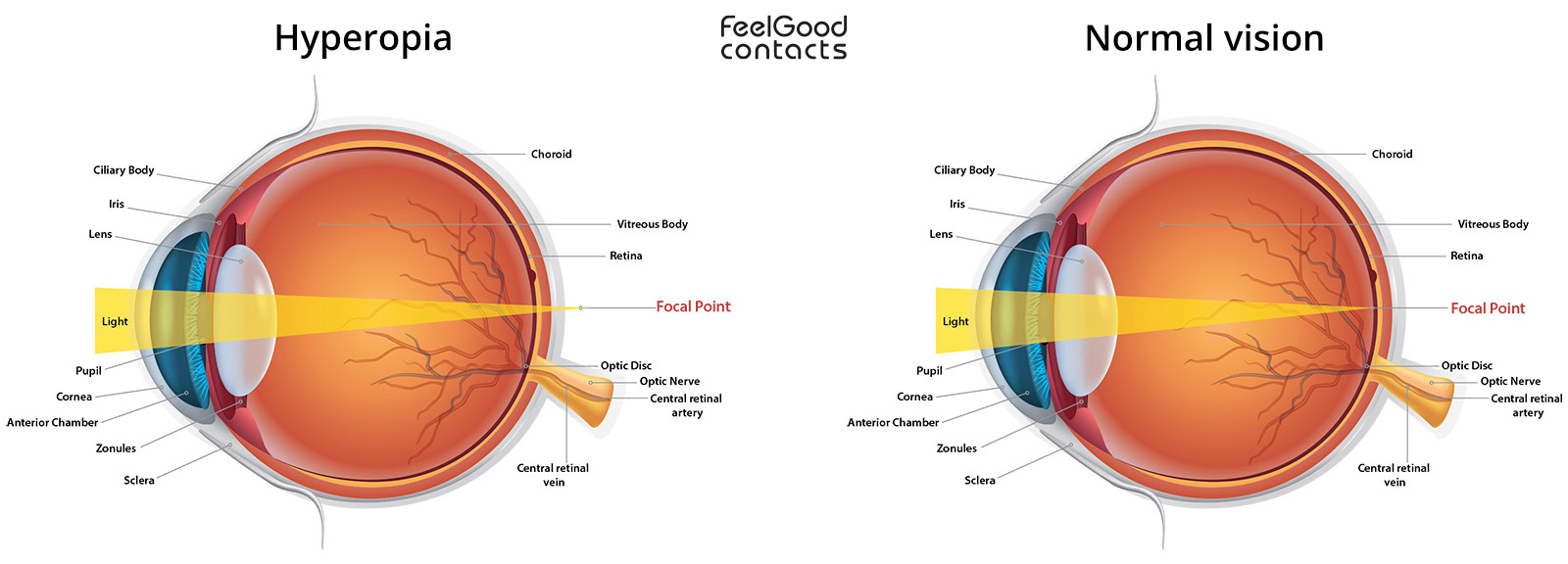 Hyperopia Lens