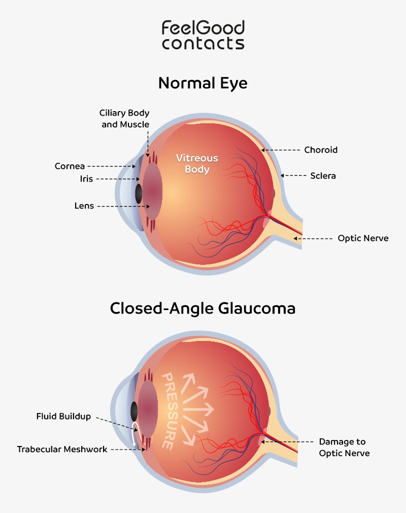 Angle-closure glaucoma causes