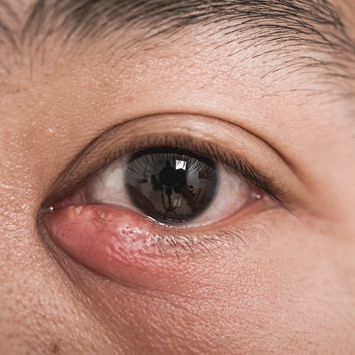 Blepharitis
