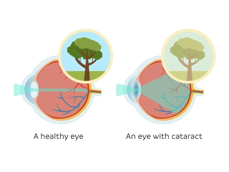 cataract symptoms