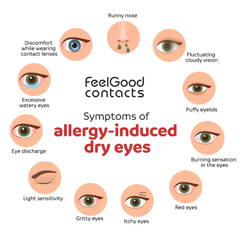 Symptoms of allergy-induced dry eyes