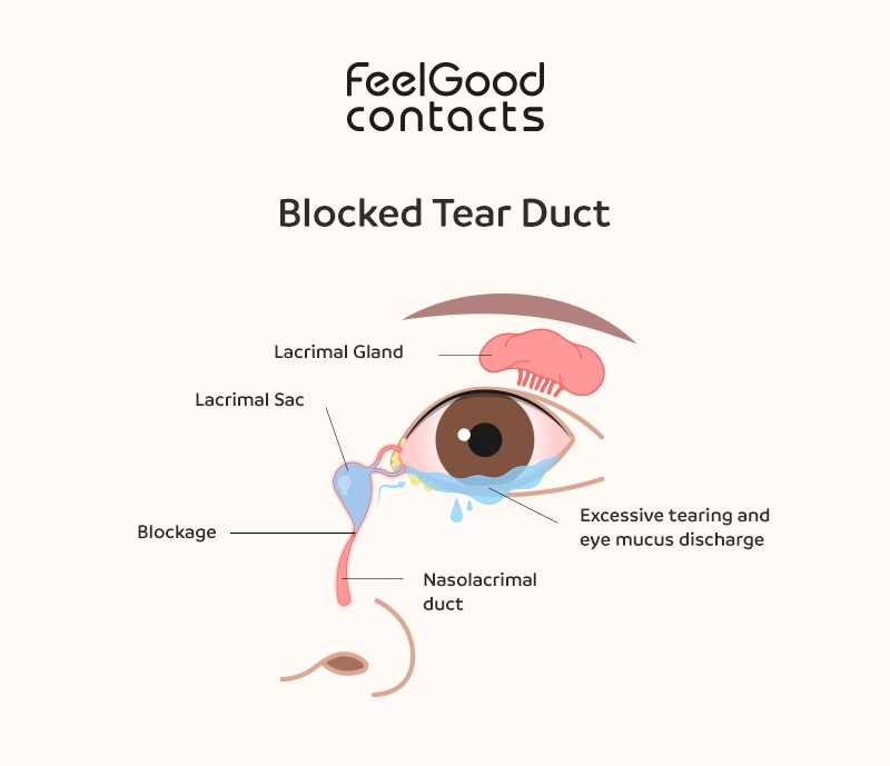 Causes of watering eyes