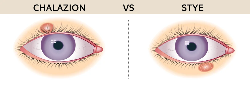 chalazion vs stye