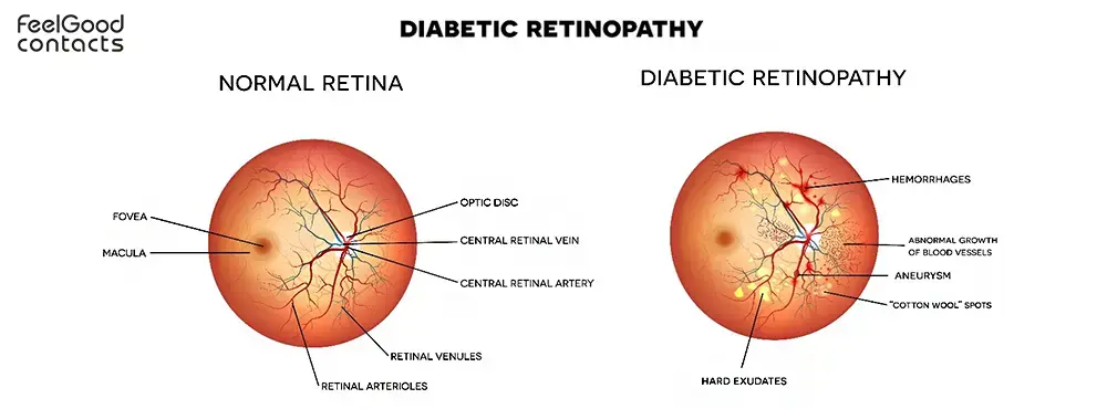 normal retina vs diabetic retinopathy