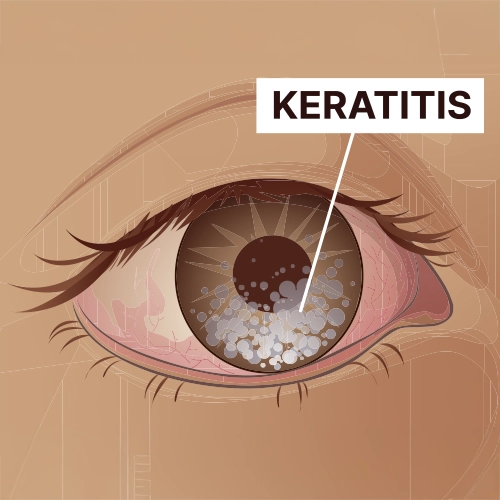 Infectious keratitis