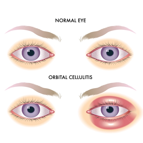 Orbital cellulitis