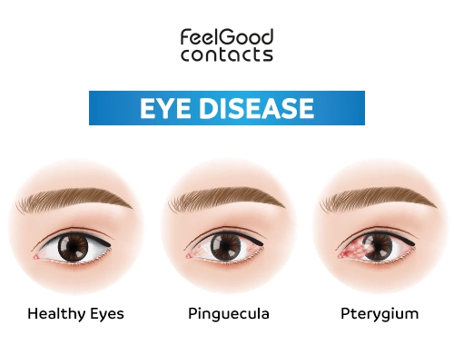 pinguecula vs pterygium