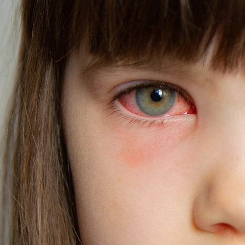 Pink eye