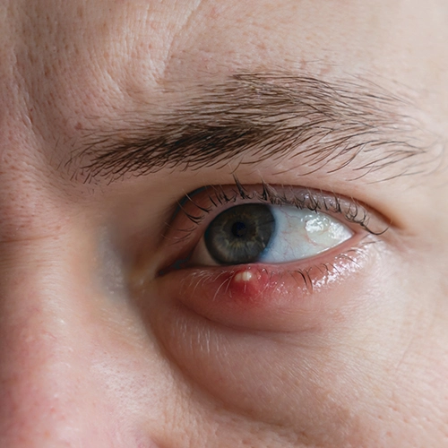 Stye