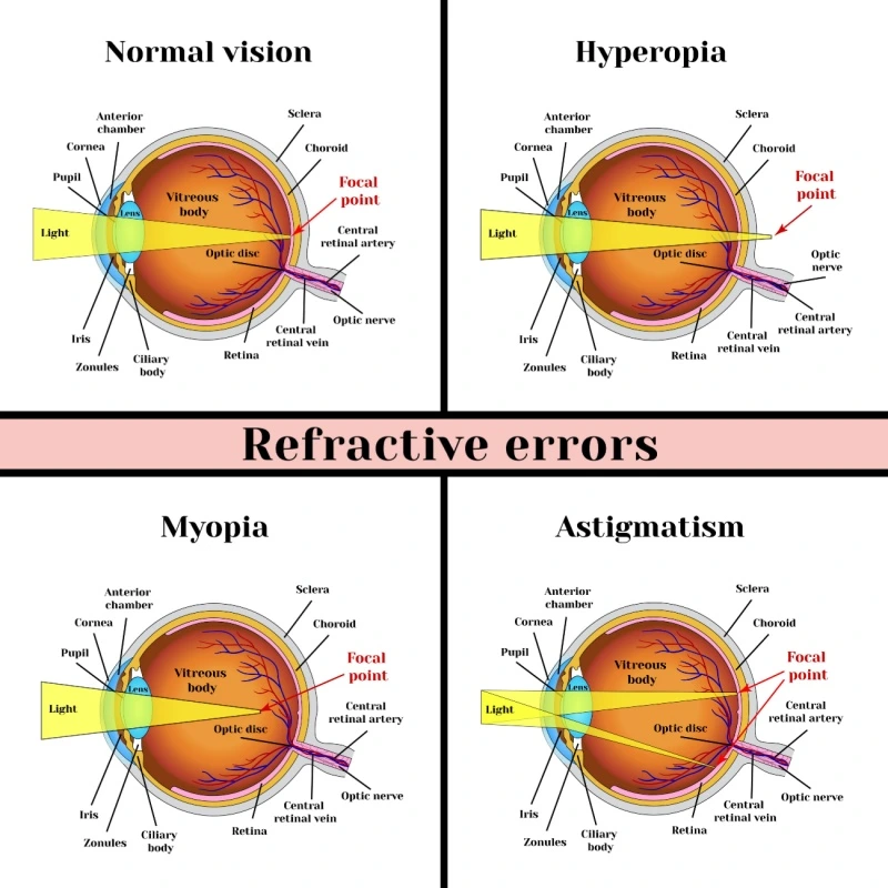 types of refractive errors