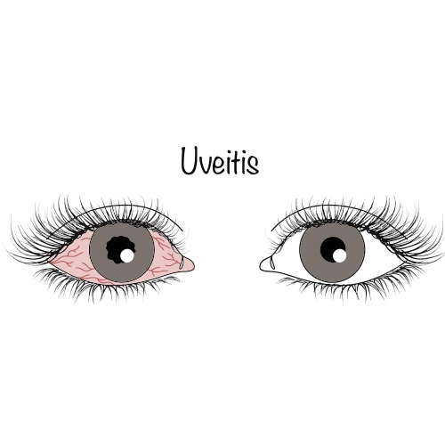 Uveitis
