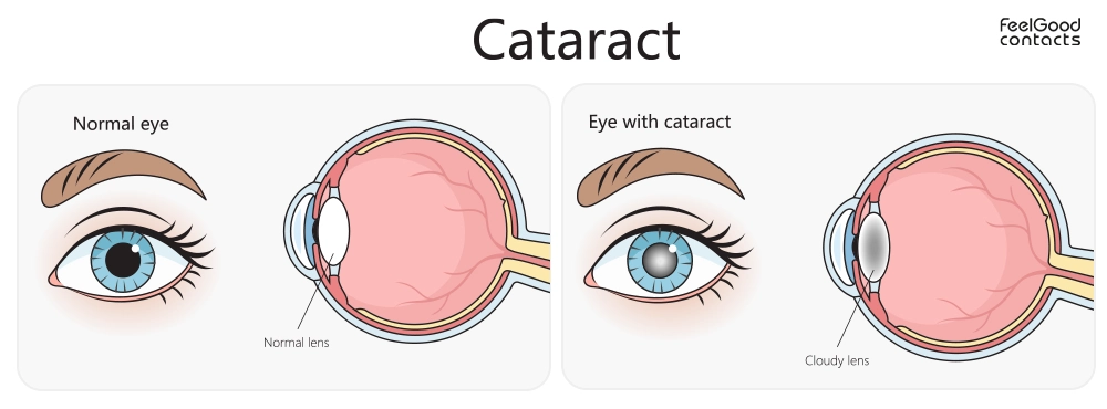 What are cataracts?
