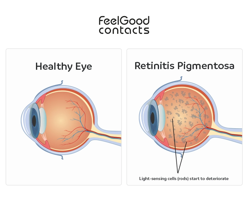 Causes of retinitis pigmentosa