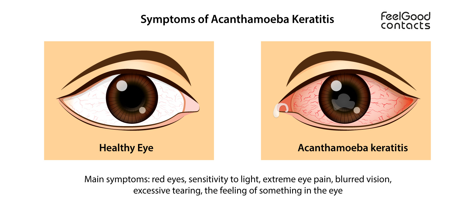 symptoms-of-acanthamoeba-keratitis