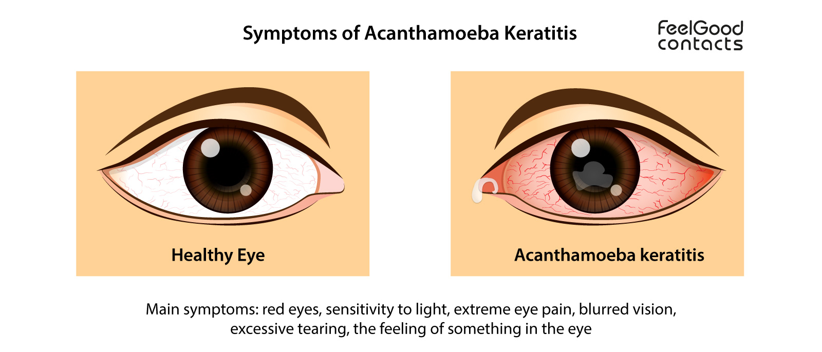 What is Acanthamoeba Keratitis? | Feel Good Contacts UK