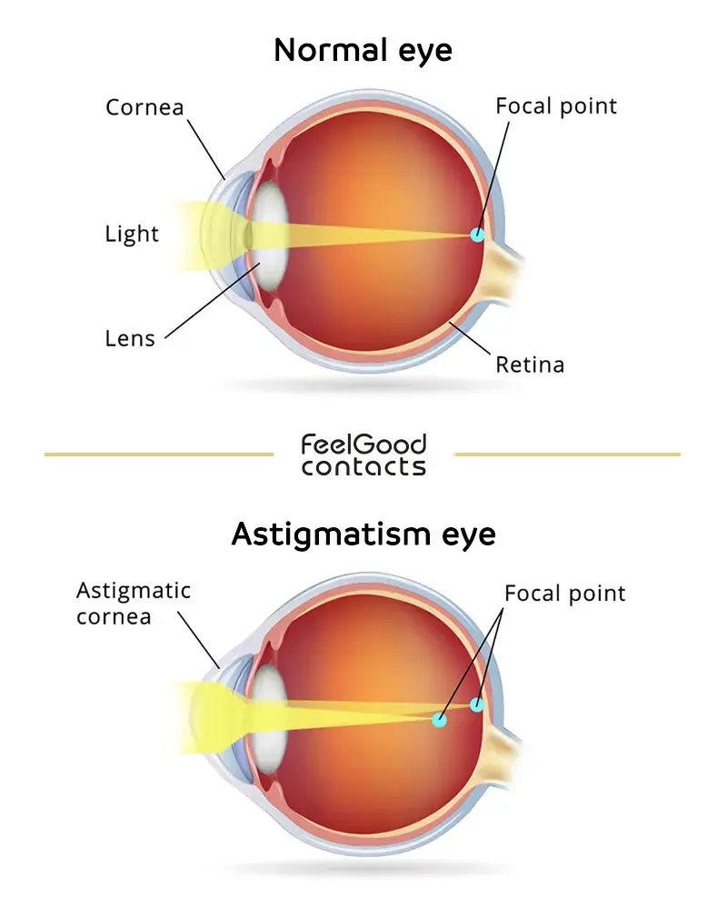 normal eye vs astigmatism
