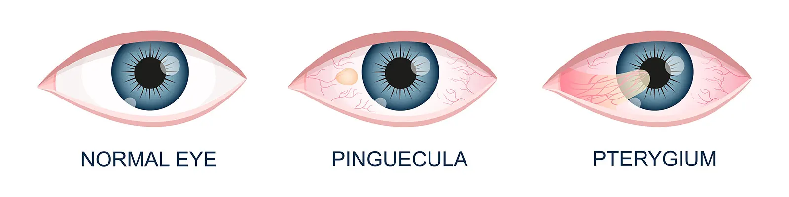 normal eye vs pinguecula and pterygium