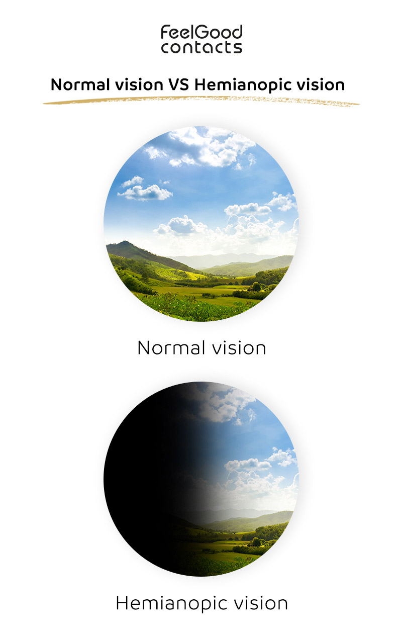 Normal vision v/s Hemianopia vision