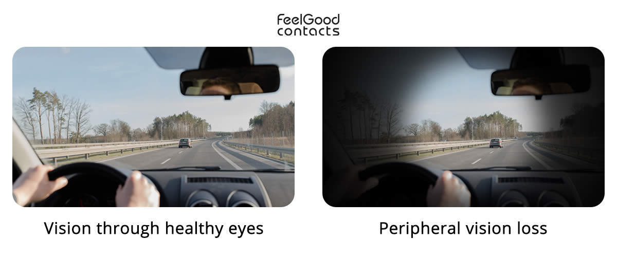 peripheral vision loss