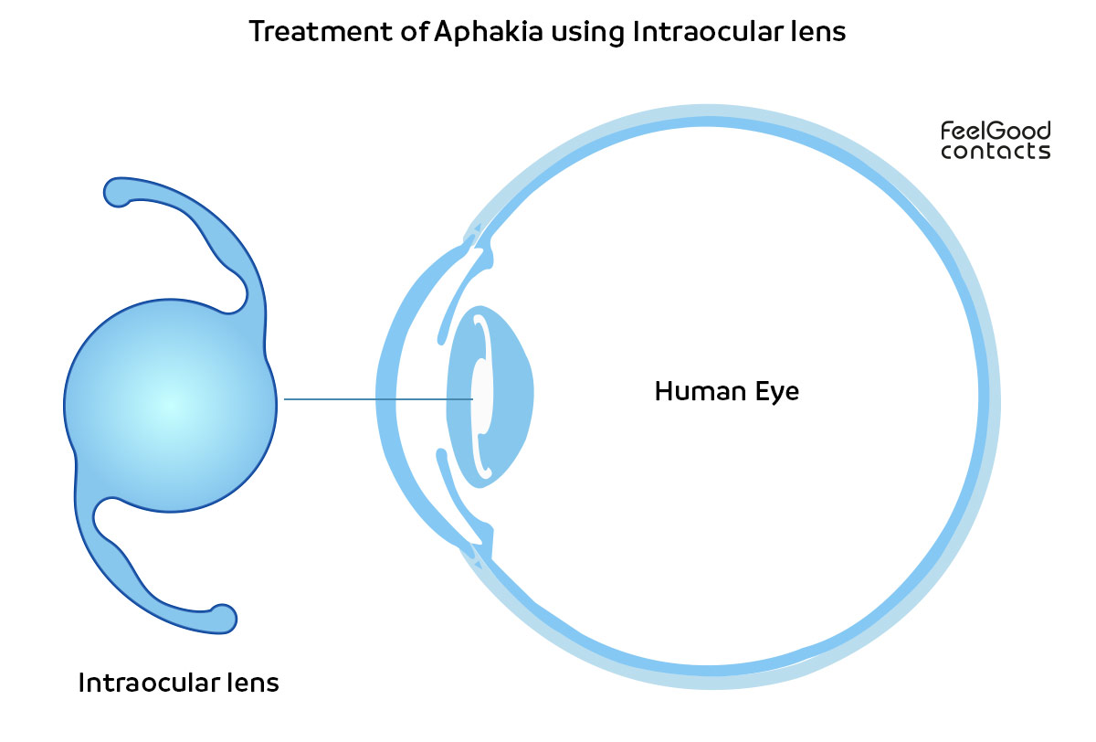 treatment of aphakia using intraocular lens updated