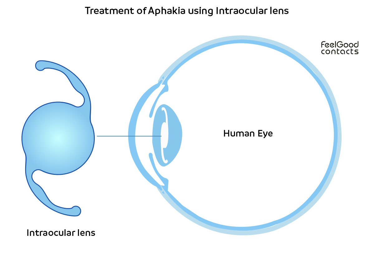 Aphakia The Absence Of The Crystalline Lens Of The Eye Feel Good Contacts 