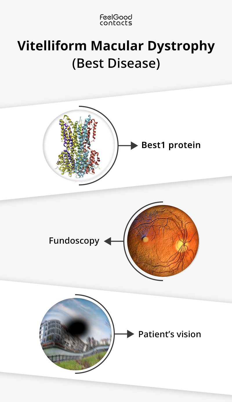 Vitelliform Macular Dystrophy: The Best disease Management | Feel Good ...