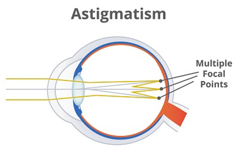 Toric Contact Lenses for Astigmatism | Feel Good Contacts UK