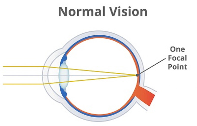 Normal Vision